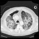 Lung fibrosis, decompensation after lobectomy: CT - Computed tomography